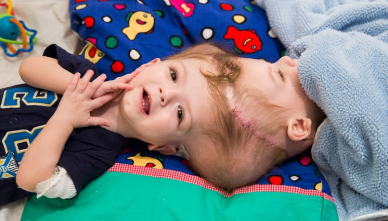 New Life Rare Surgery To Separate Conjoined Twins Pregnant Life